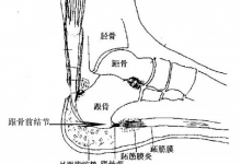 【完美解决】长期打羽毛球导致脚后跟钻心的疼：足底筋膜炎